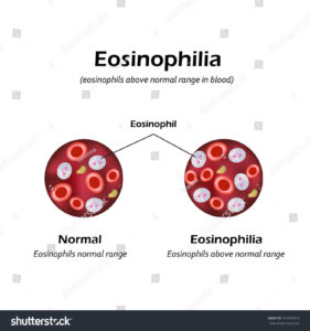 Эозинофилия