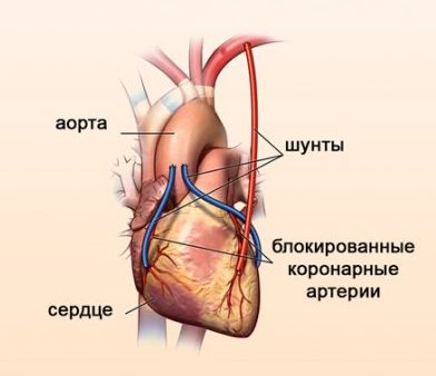 Дела сердечные: когда аортокоронарное шунтирование - единственный выход