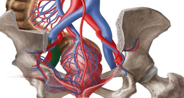 Варикозное расширение вен малого таза